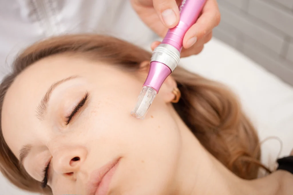 MaisonDestetica Microneedling 1